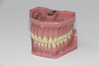 dentures-1514697_960_720
